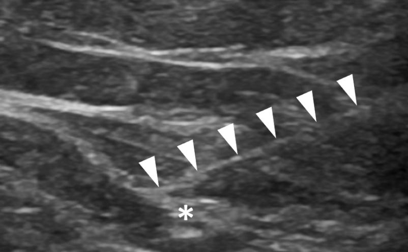 Meralgia parestesica tempo formacion ecografia 5.jpg